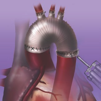 Coseal Surgical Sealant