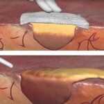 Matriz Hemostática Floseal