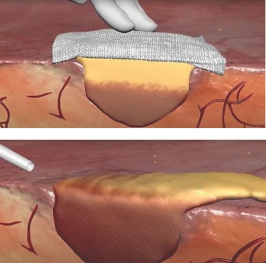 Floseal Haemostatic Matrix