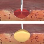 Matriz Hemostática Floseal