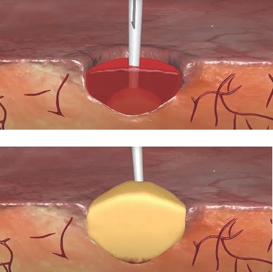 Matriz Hemostática Floseal