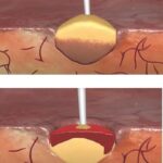 Matriz Hemostática Floseal